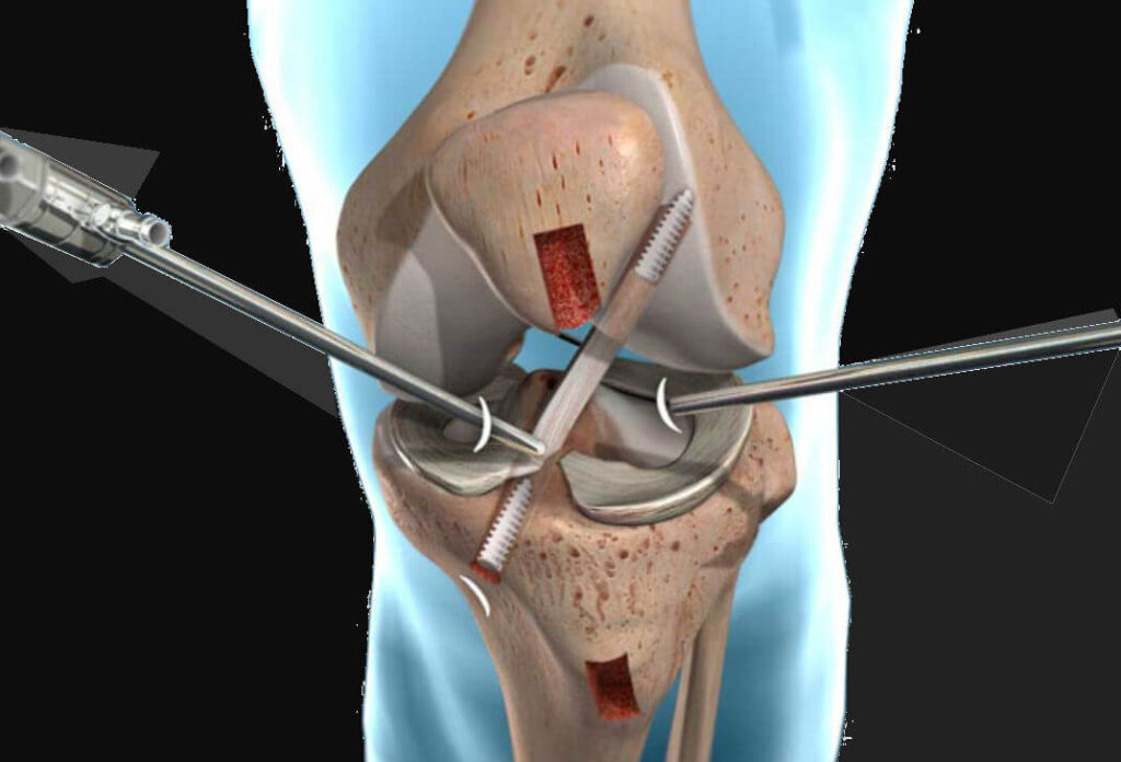 ACL surgery Perth.