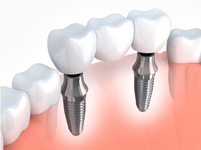 Dential implants Brisbane.